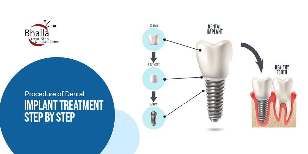 Procedure of Dental Implant Treatment Step-by-Step
