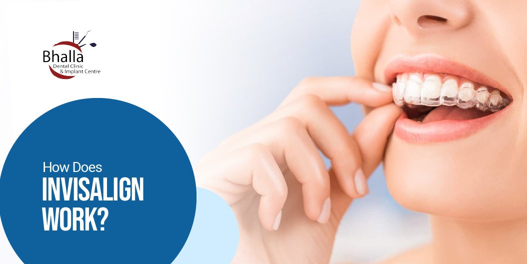 How Does Invisalign Work? A Step-by-Step Guide