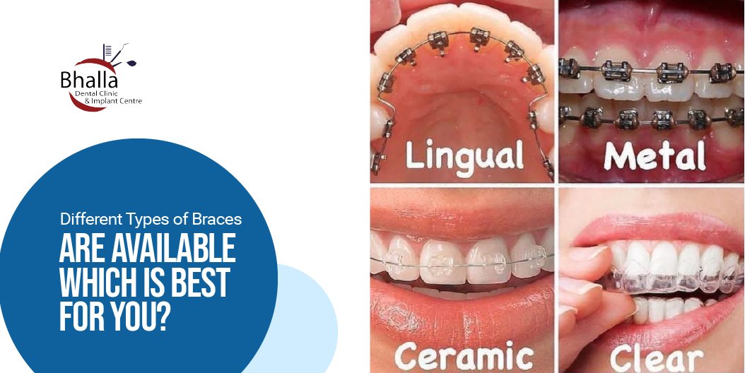 Different Types of Braces Are Available — Which Is Best for You?