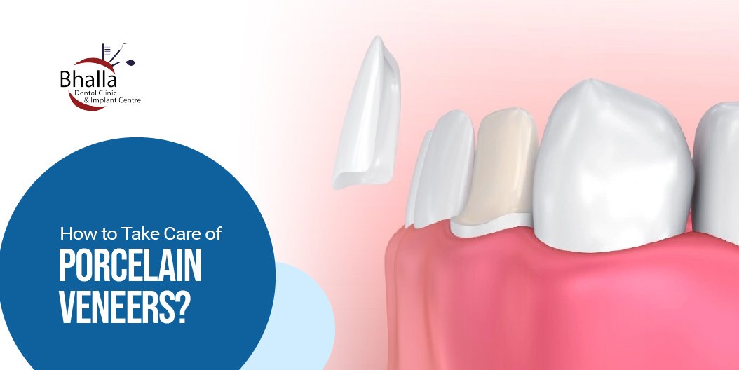 How to Take Care of Porcelain Veneers?