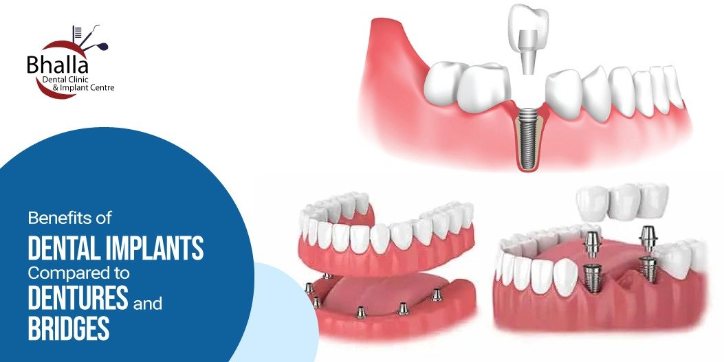 Benefits of Dental Implants Compared to Dentures and Bridges