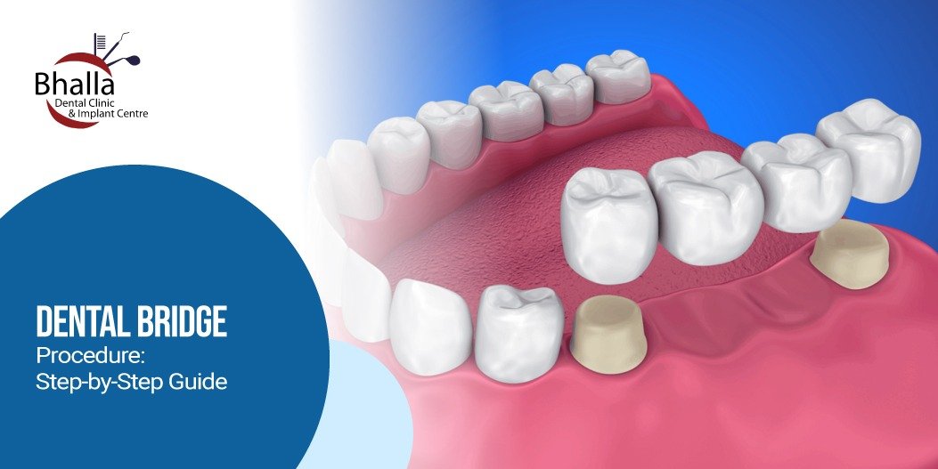 Dental Bridge Procedure | Step-by-Step Guide