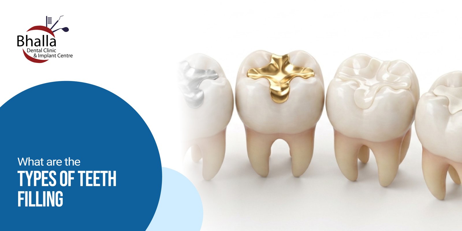 Different Types of Teeth Fillings Explained | Complete Guide