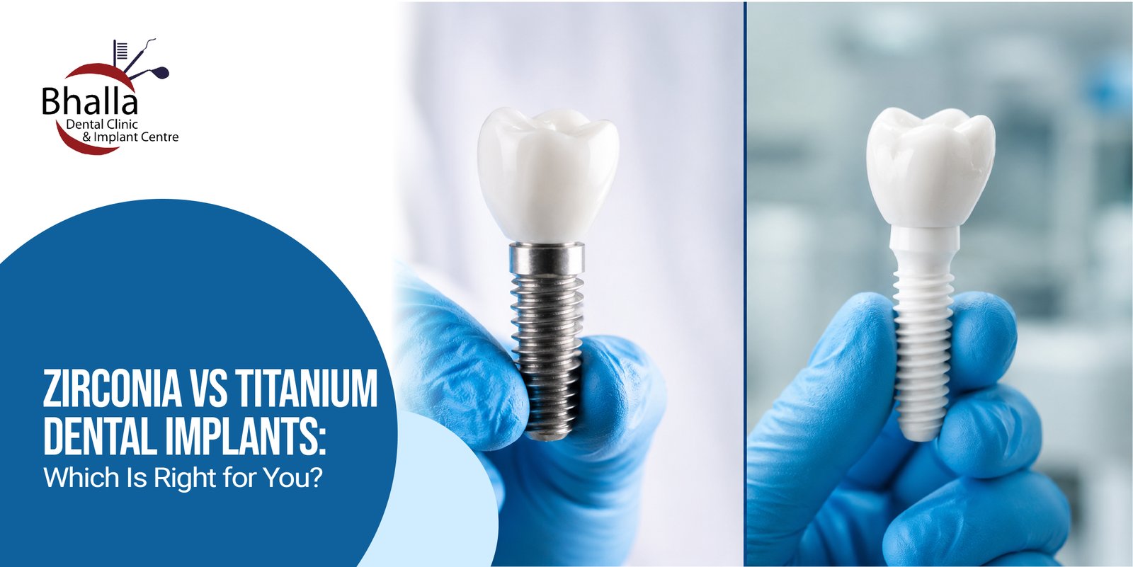 Zirconia vs Titanium Dental Implants: Which Is Right for You?