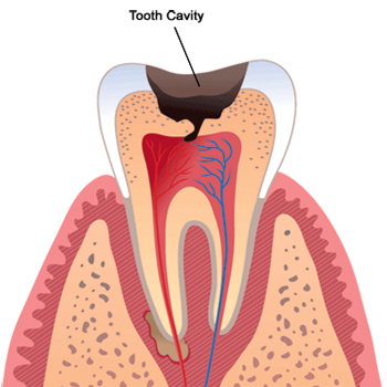 tooth-cavity